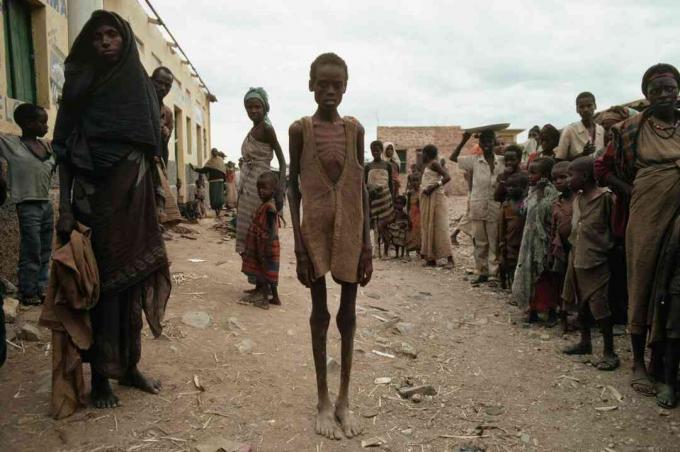 Opfer der Hungersnot infolge des Bürgerkriegs in Somalia.